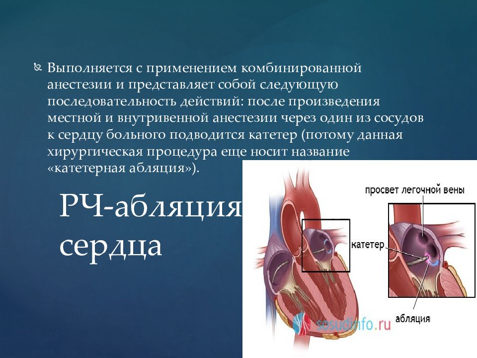 Абляция сердца. Комбинированная анестезия представляет собой. Анестетик при аритмии. Последовательность действий при комбинированном наркозе. Хирургическое лечение аритмий.