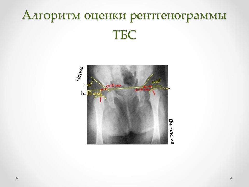 Алгоритм оценки рентгенограммы ТБС