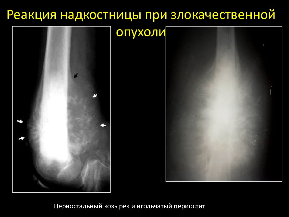 Признаки надкостницы. Козырьковый периостит рентген. Реакция надкостницы на рентгене. Воспаление надкостницы. Воспаление надкостницы рентген.