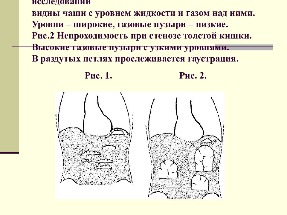 Горизонтальные уровни жидкости. Газовый пузырь с горизонтальным уровнем жидкости. Газовый пузырь в кишечнике. Уровни жидкости в кишечнике. Горизонтальные уровни в кишечнике.