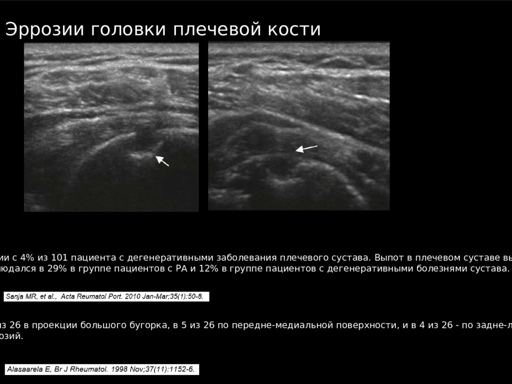 Узи плечевого сустава. УЗИ плечевого сустава методика исследования. УЗИ плечевого сустава лекция. Лимб плечевого сустава УЗИ. УЗИ плечевого сустава последовательность.