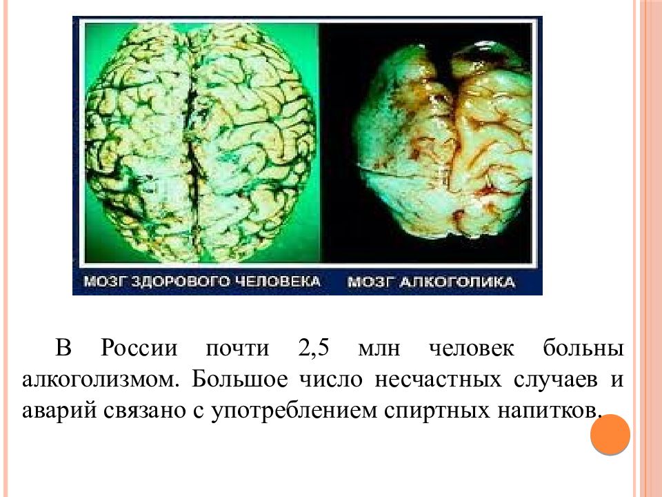 Мозг алкоголика и здорового человека картинки