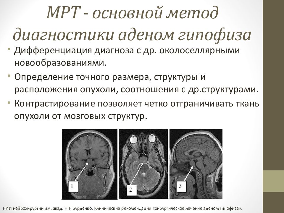 Аденома гипофиза презентация