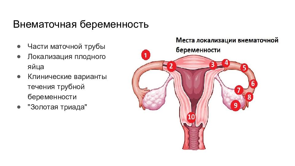 Внематочная беременность картинки для презентации