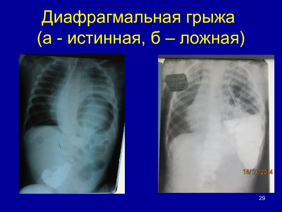 Грыжи у детей презентация