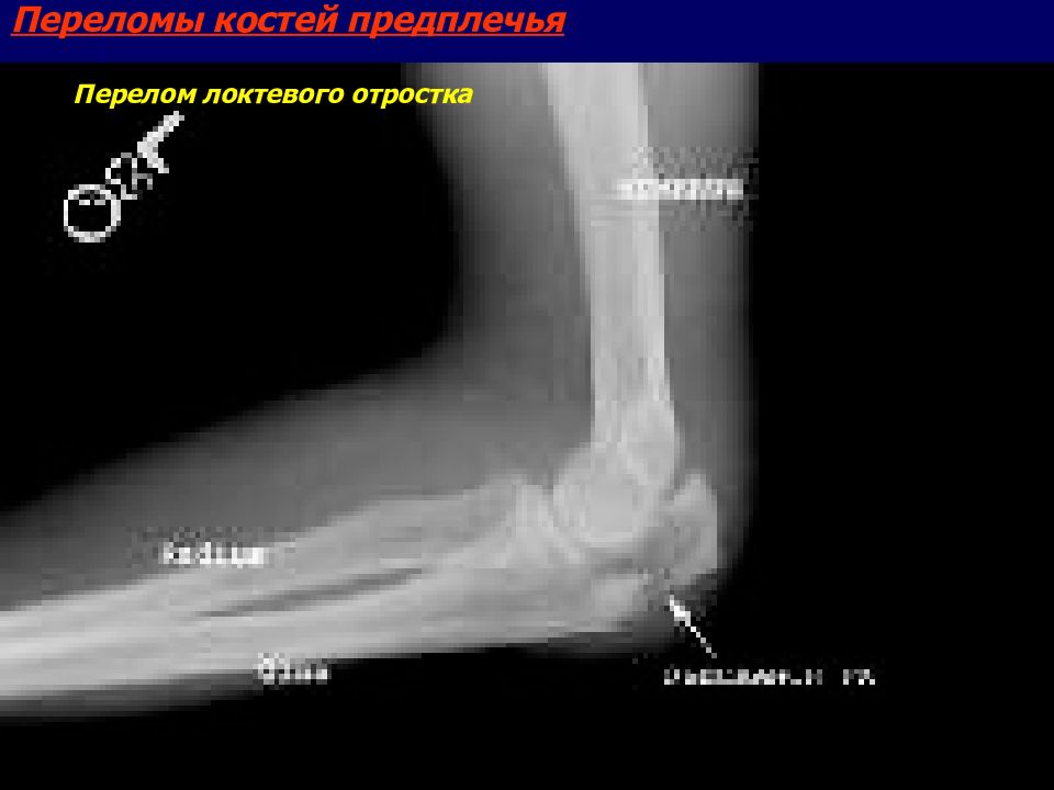 Локтевой отросток локтевой кости. Перелом локтевого отростка кт. Мкб перелом венечного отростка локтевой кости. Краевой перелом локтевого отростка. Отрыв локтевого отростка рентген.