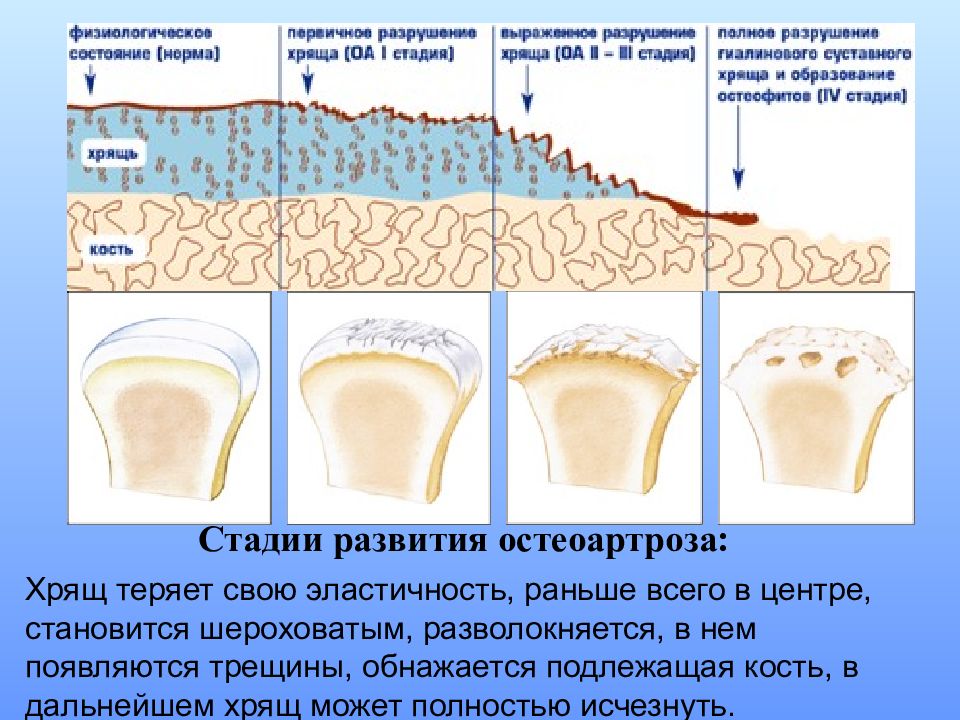 Что значит остеоартроз 2 степени. Схема развития деформирующего остеоартроза. Стадии развития остеоартроза.