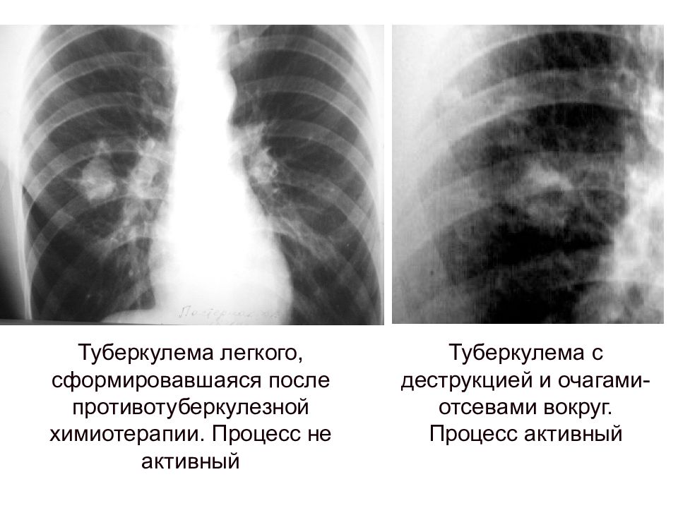 Туберкулома легких картинки