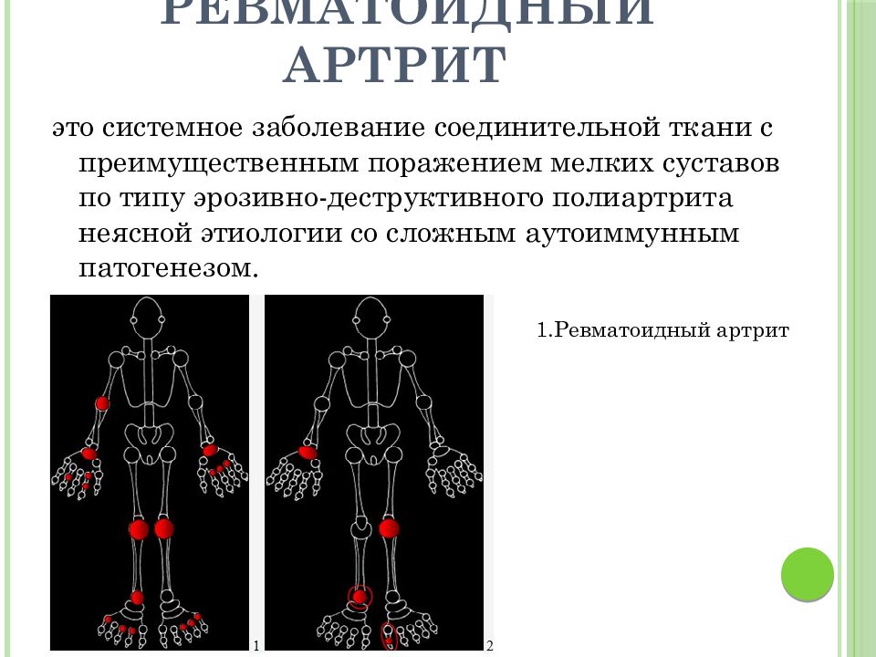 Ревматический полиартрит презентация