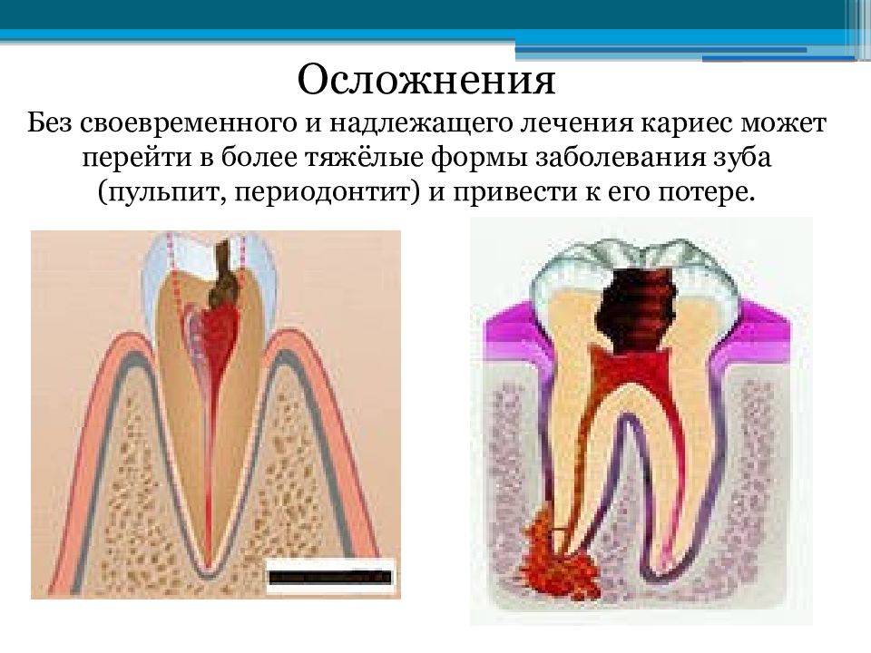 Развитие кариеса в картинках