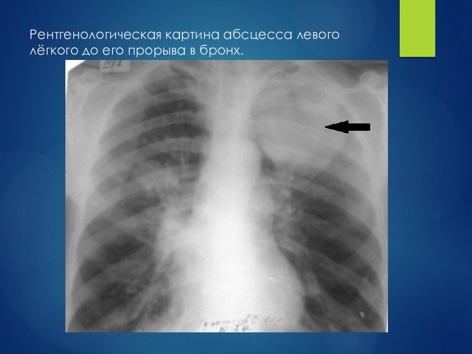 Рентгенологическая картина. Абсцесс верхней доли левого легкого. Рентген при абсцессе легкого. Рентгенологическая картина абцесс легкого. Рентгенологическая картина абсцесса легкого.