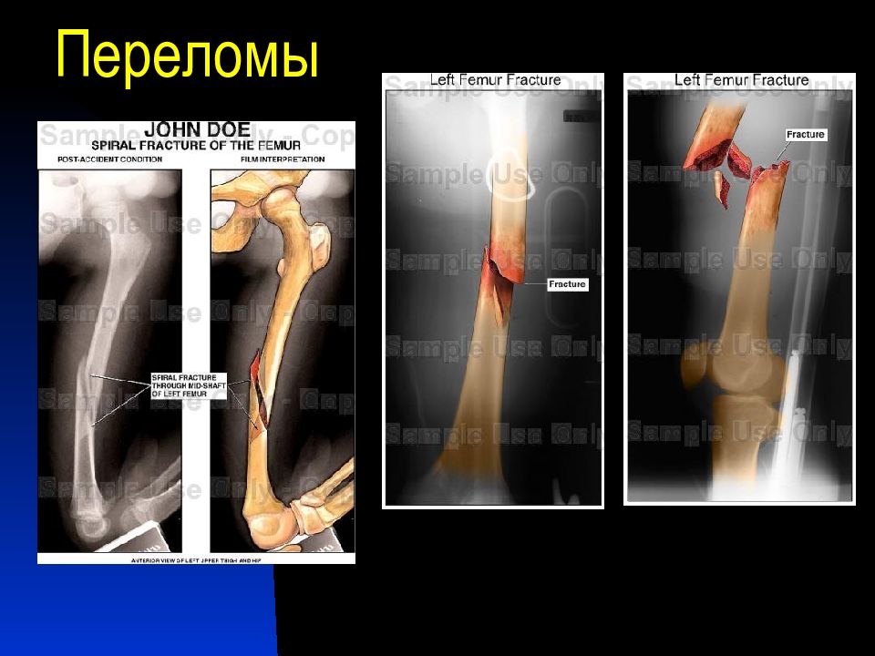 Перелом скелета человека