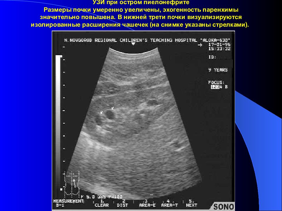 Узи картина. УЗИ почек при хроническом пиелонефрите. Парапельвикальные кисты почек на УЗИ. Солитарная киста почки УЗИ. Киста паренхимы почки УЗИ.