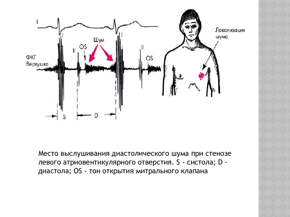 Тон открытия митрального клапана ФКГ. Диастолические шумы сердца. Митральный стеноз шум. Диастолический шум выслушивается.