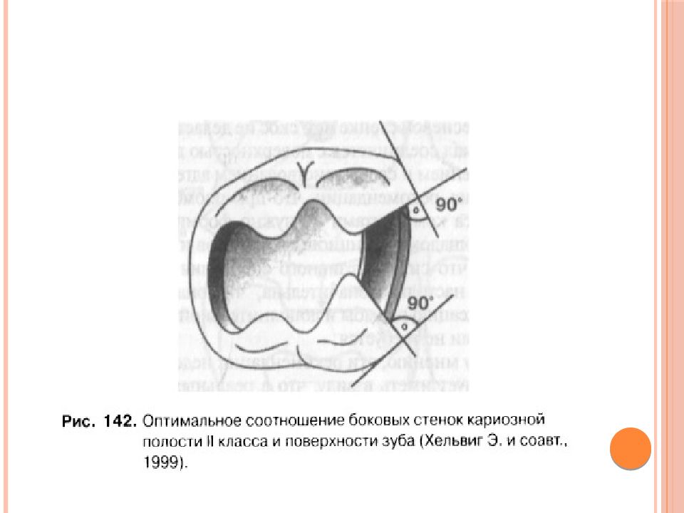 Придесневая стенка кариозной полости