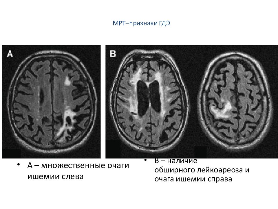 Болезнь альцгеймера картина мрт