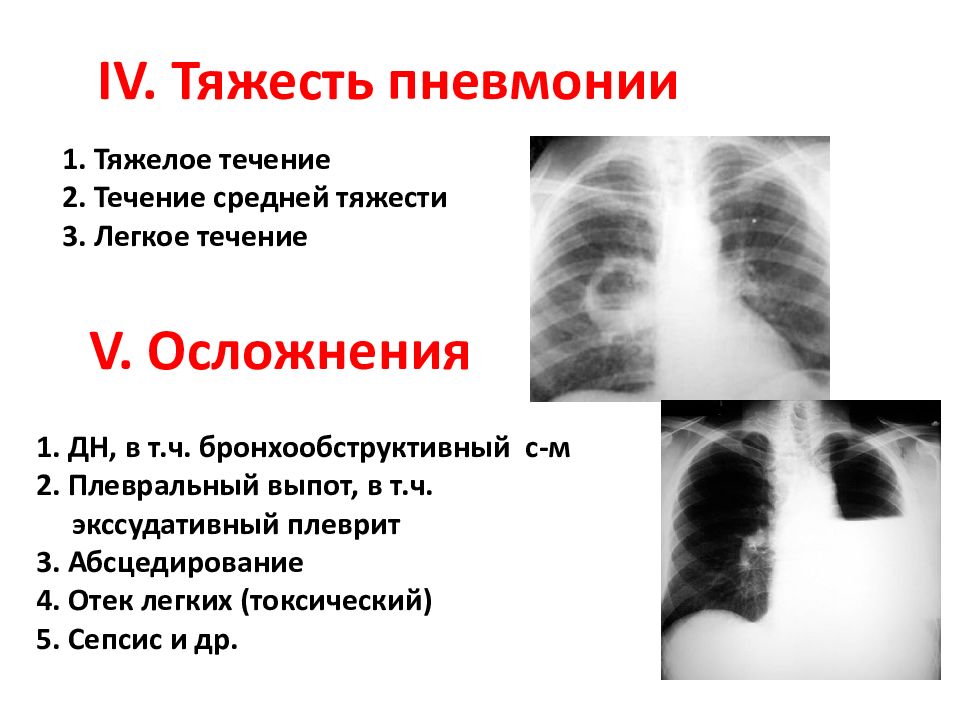 Поражен легких 3. Пневмония поражение легких. Двухсторонняя пневмония.