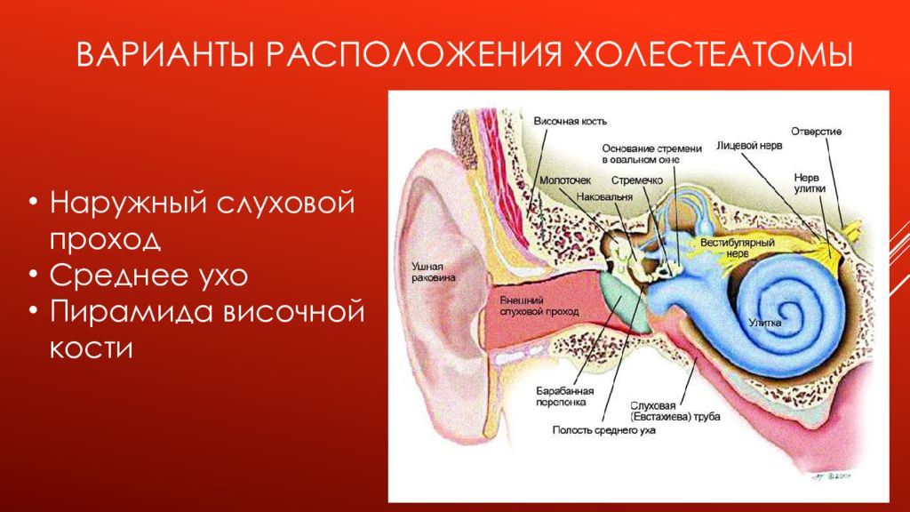 Внутреннее ухо расположено в полости. Холестеатома барабанной полости. Холестеатома сосцевидного отростка. Строение внутреннего уха анатомия косточки. Холестеатома ячеек сосцевидного отростка.