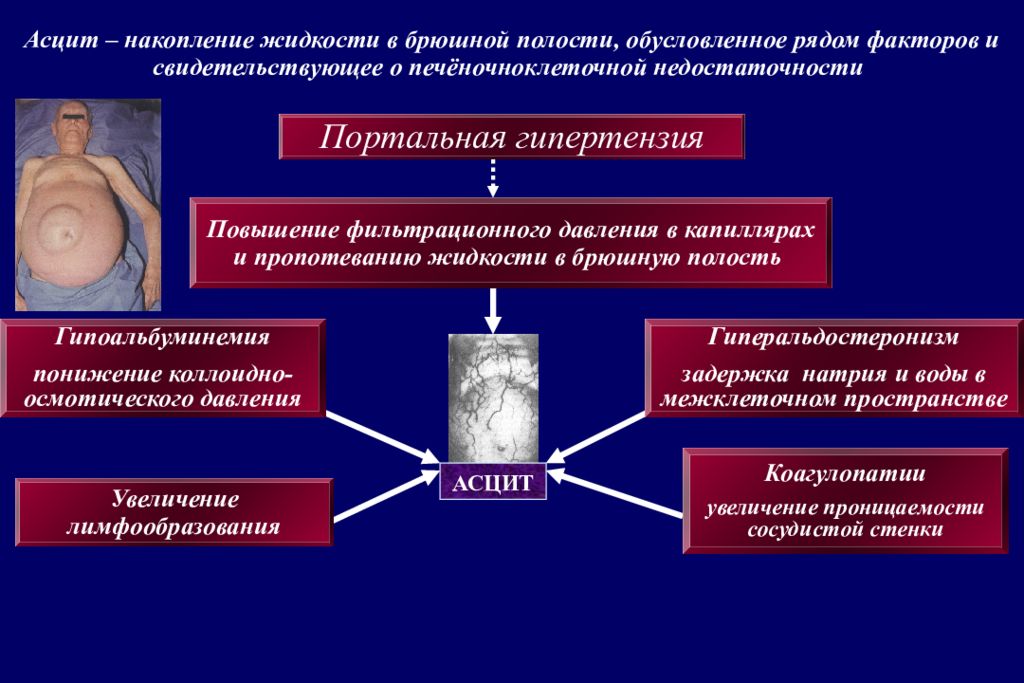 Асцит Печени Фото