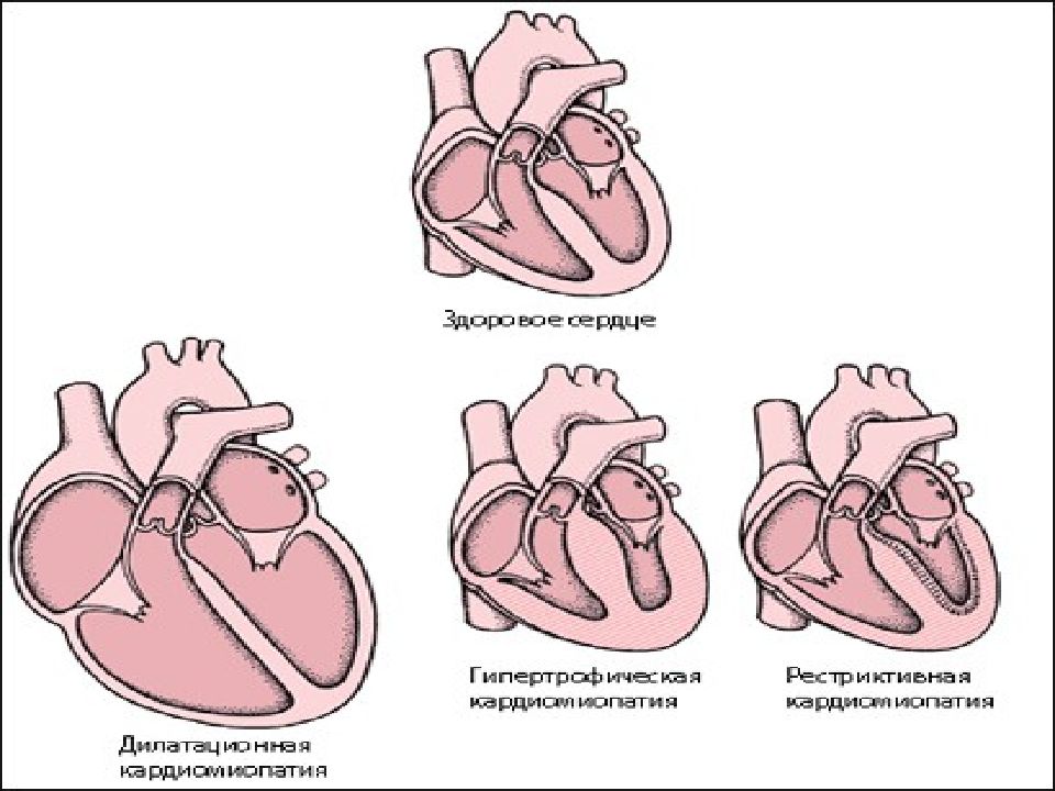 Кардиомиопатии у детей презентация