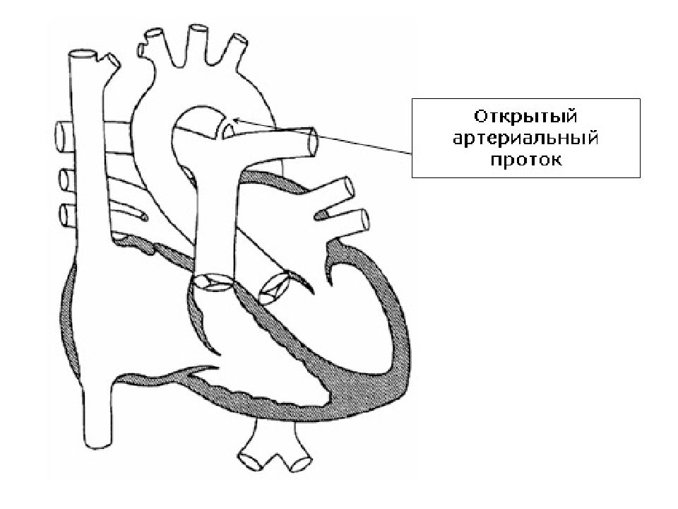 Открытый артериальный проток у детей