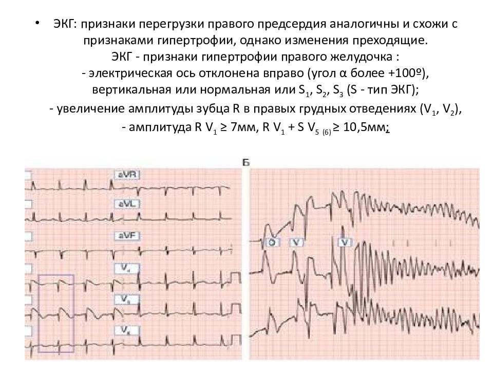 Признаки перегрузки. Гипертрофия правых отделов сердца на ЭКГ. Гипертрофия правого желудочка на ЭКГ. Гипертрофия правого предсердия на ЭКГ. Признаки перегрузки предсердий на ЭКГ.