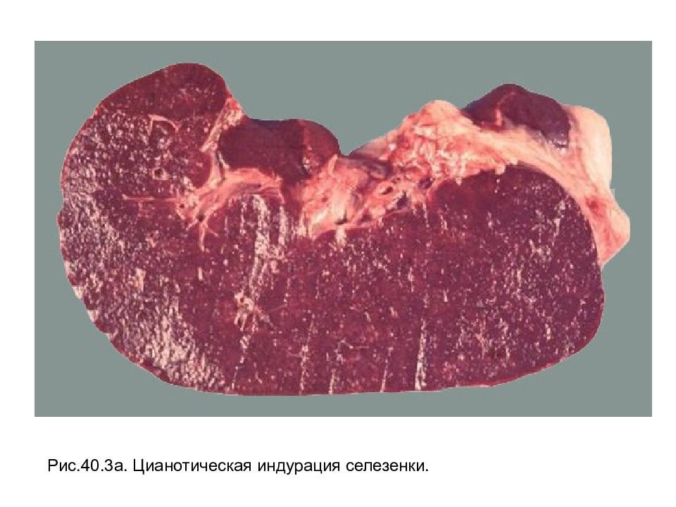 Порфировая селезенка. Цианотическая индурация. Цианотическая индурация селезенки патанатомия. Цианотическая индурация почек. Цианотическая индурация селезенки макропрепарат.