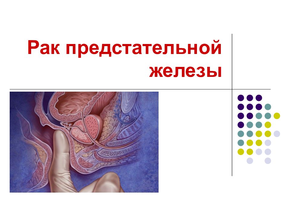 Рак предстательной железы