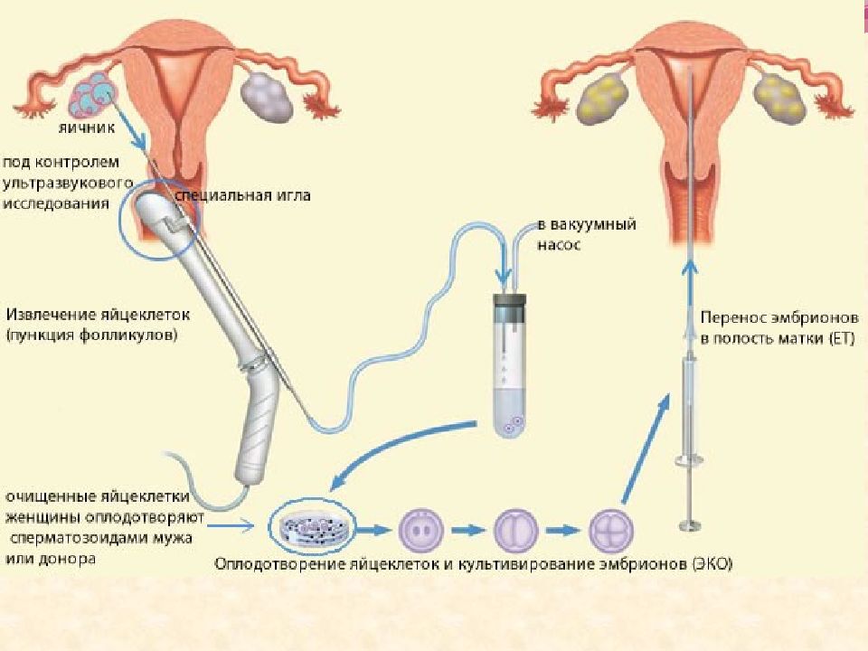 Ем эко. Схема экстракорпорального оплодотворения. Эко пункция яйцеклеток. Пункция фолликулов картинки. Пункция забора яйцеклетки.