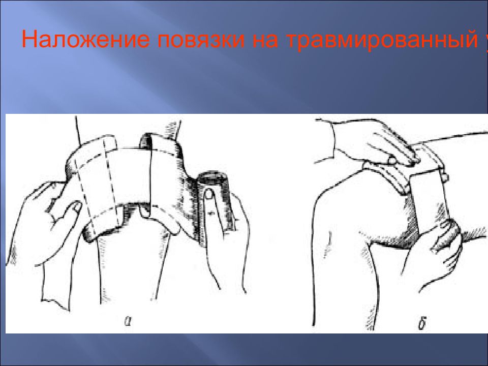 Наложение повязки на рану. Наложение повязки сквозное отверстие. Наложение теплоизолирующей повязки на повреждённые участки тела. Наложить повязку при травматической эвентрации. Пролива при наложении повязки.