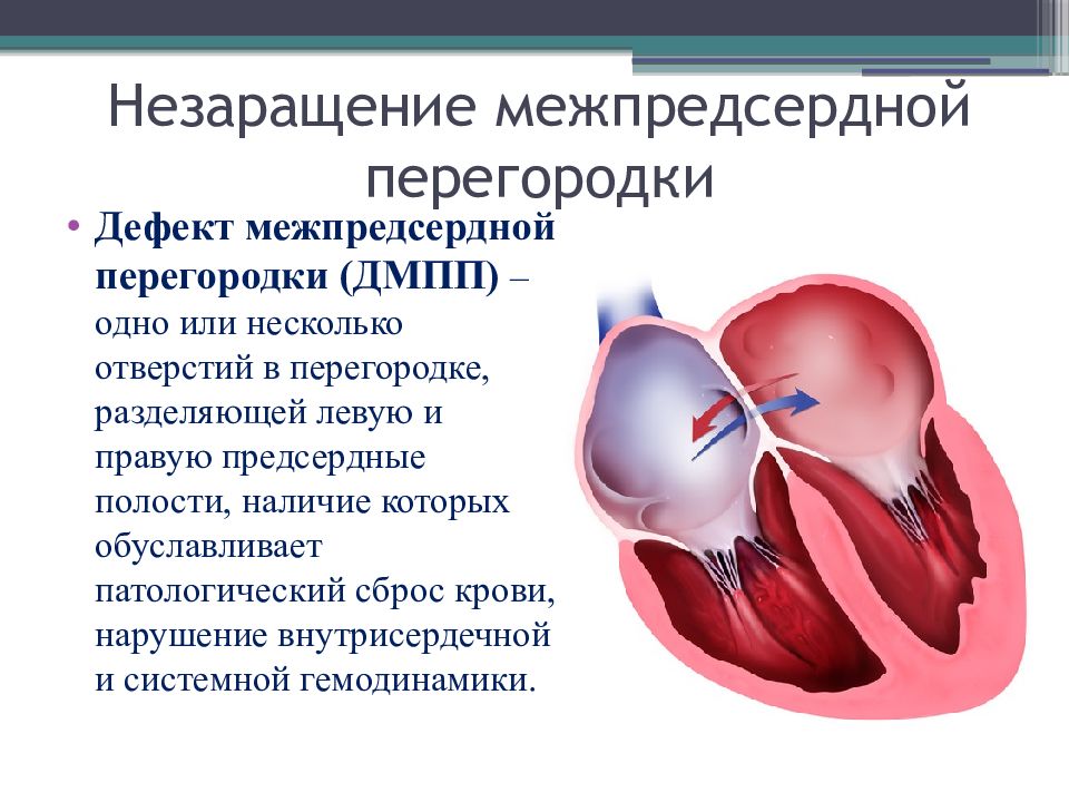 Перегородки сердца. Дефект межпредсердной перегородки. Дефект межпредсердной перегородки гемодинамика. ДМПП гемодинамика. Дефект межпредсердной перегородки клиника.