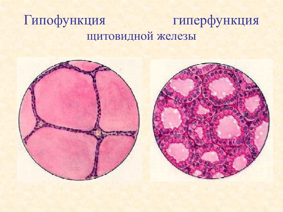 Гипо щитовидной железы