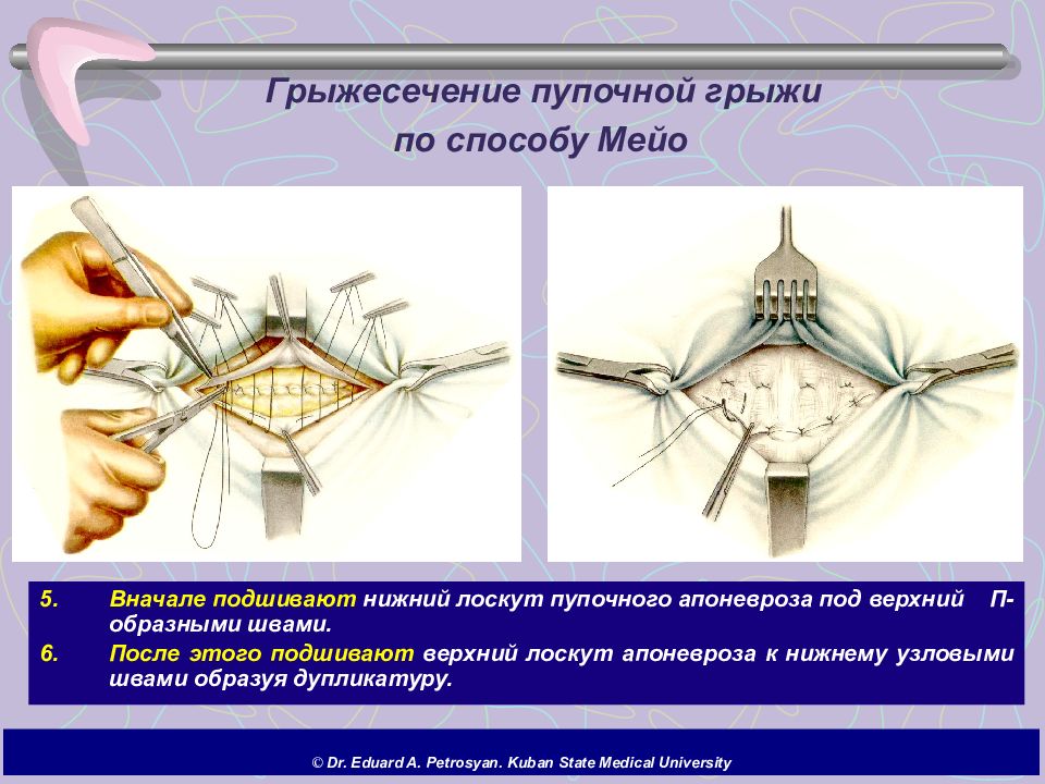 Способы пластики грыж