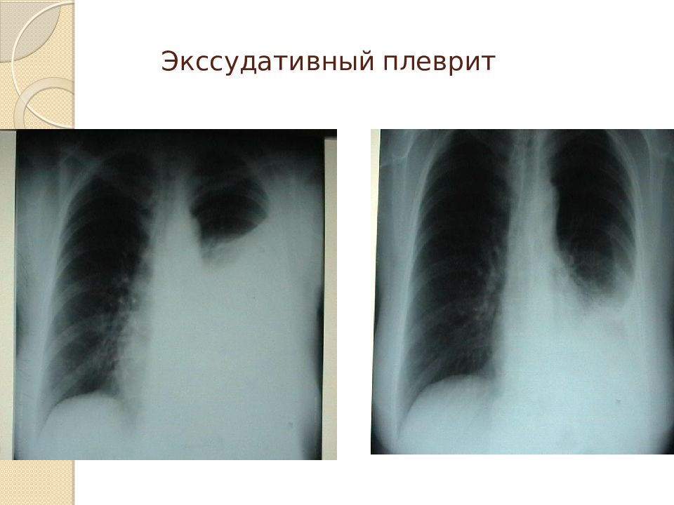 Плеврит симптомы. Пневмония с плевральным выпотом. Экссудативный плеврит. Парапневмонический экссудативный плеврит.