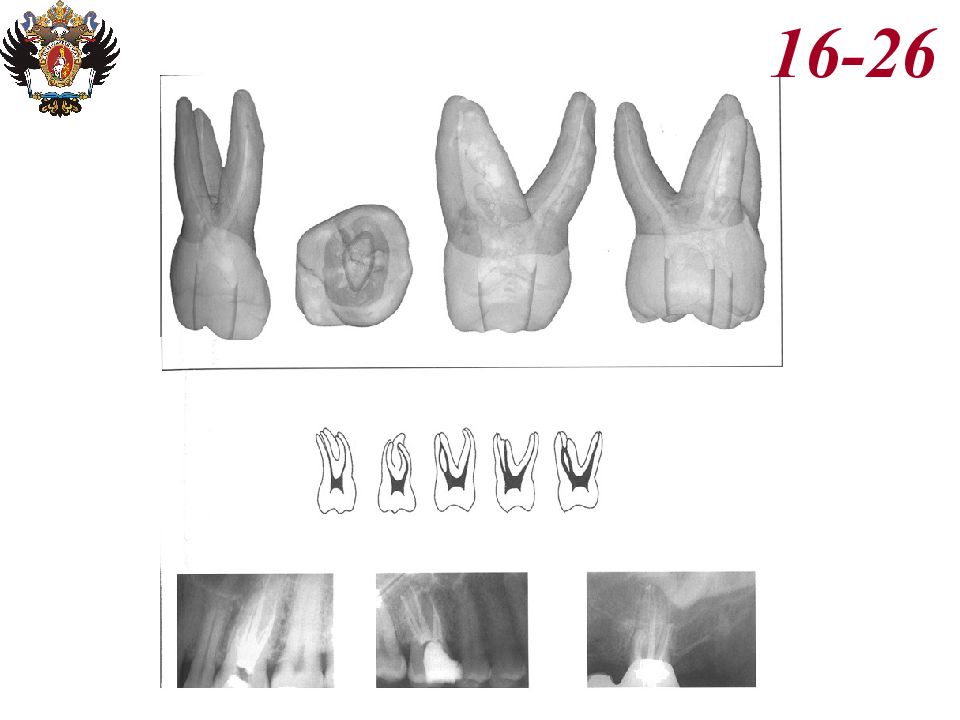 Анатомия каналов. 26 Зуб анатомия корневых. Топография каналов 26 зуба. Расположение корневых каналов в 26 зубе.