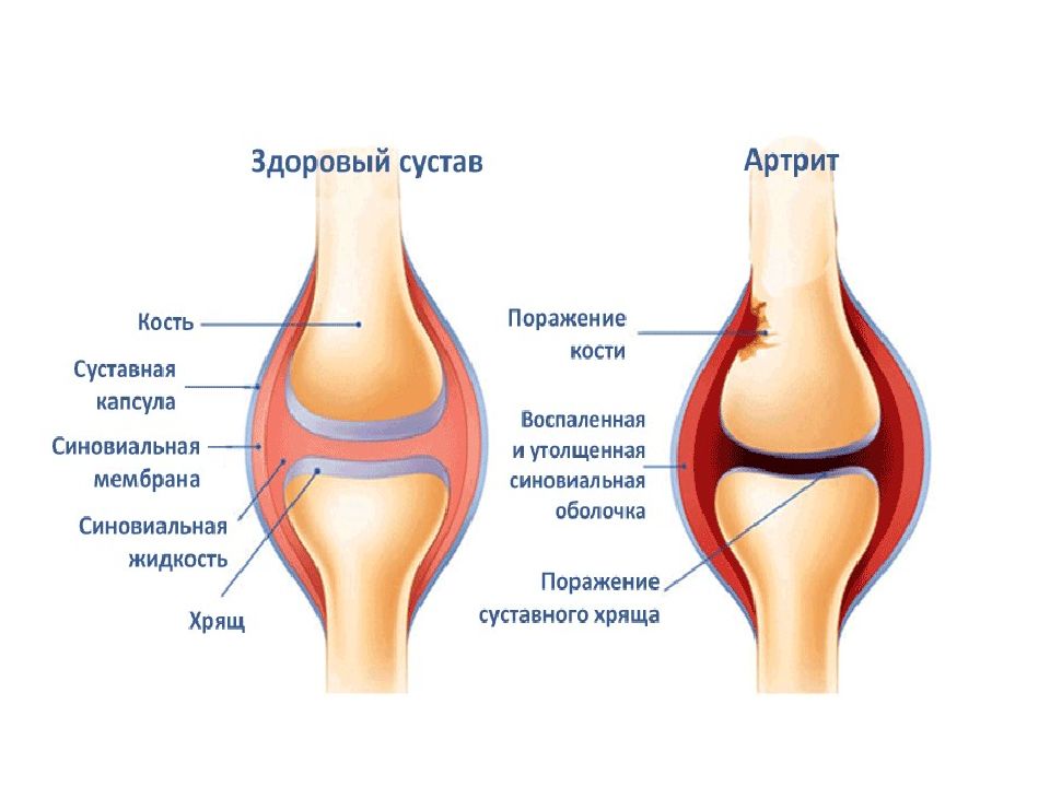 Ревматоидный артрит классификация коленный сустав. Строение сустава. Суставная капсула коленного сустава. Строение сустава человека. Ревматоидный артрит классификация коленный сустав. Строение сустава. Суставная капсула коленного сустава. Строение сустава человека.