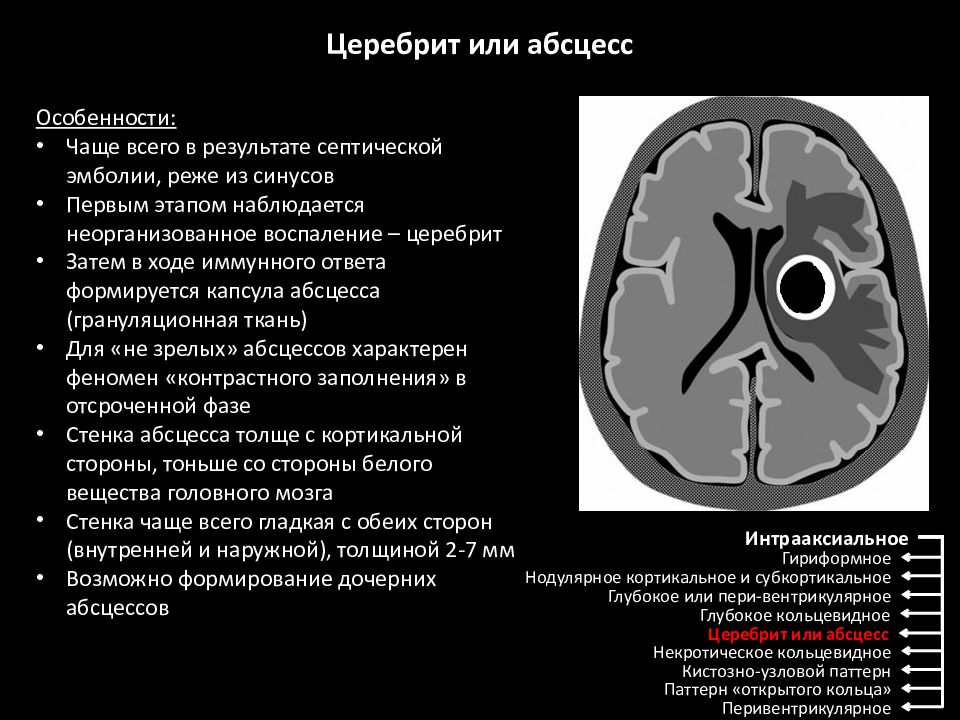 Презентация абсцесс головного мозга