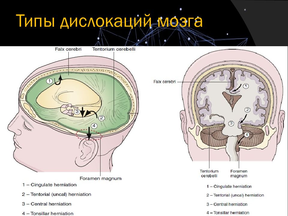 Синдром внутричерепной гипертензии патофизиологические механизмы клиническая картина