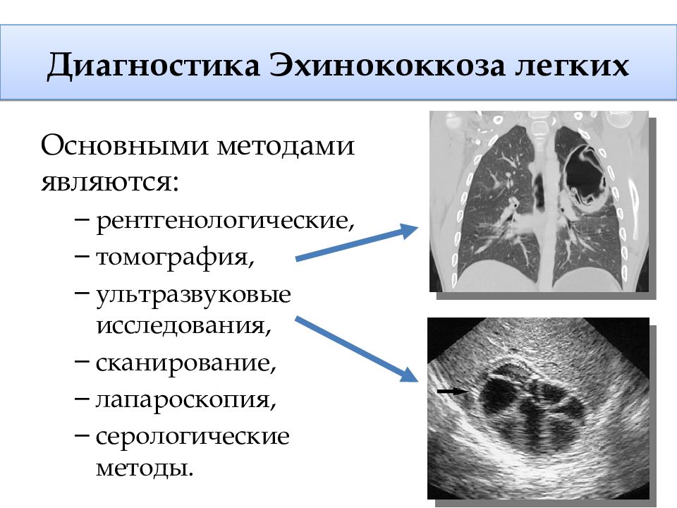 Эхинококкоз легких кт картина