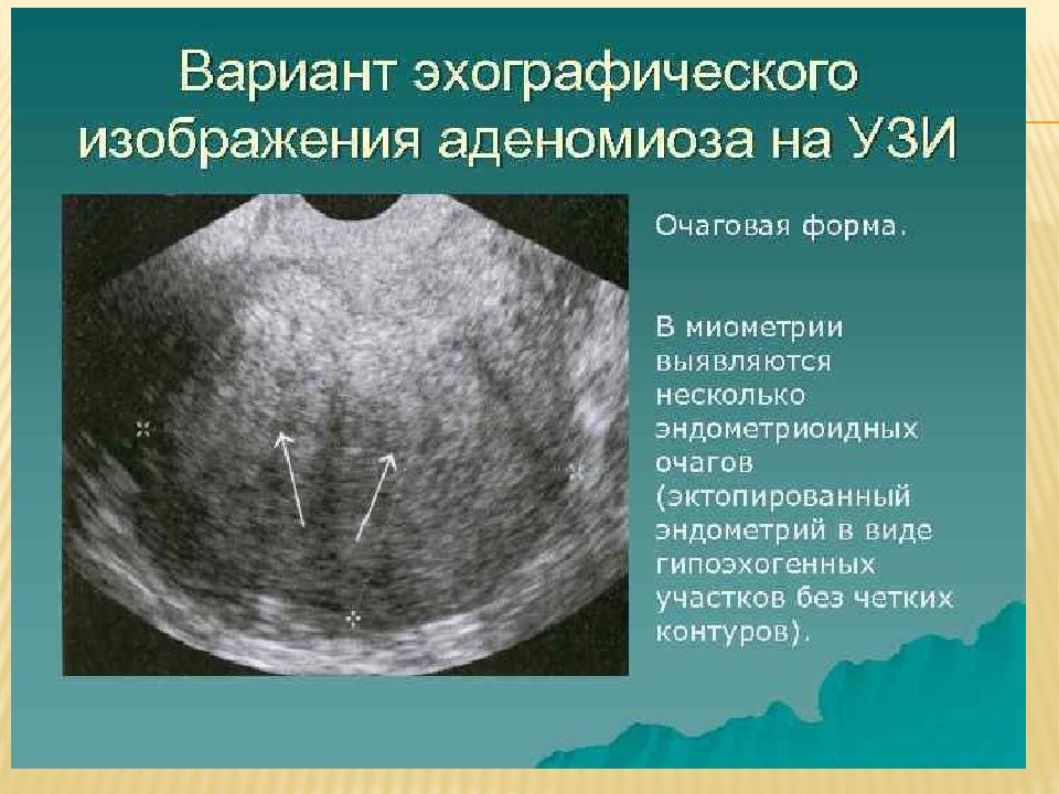 Эндометрия стенок матки. Очаговый аденомиоз на УЗИ. Диффузно Узловая форма эндометриоза. Узловая форма аденомиоза по УЗИ.