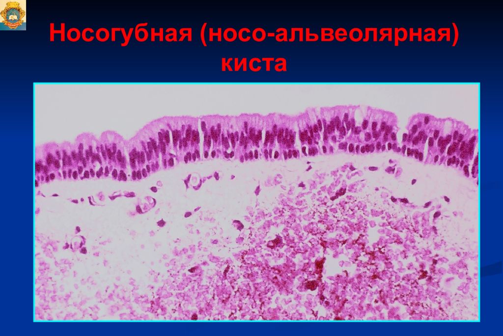 Опухоли опухолеподобные поражения и кисты кожи лица презентация