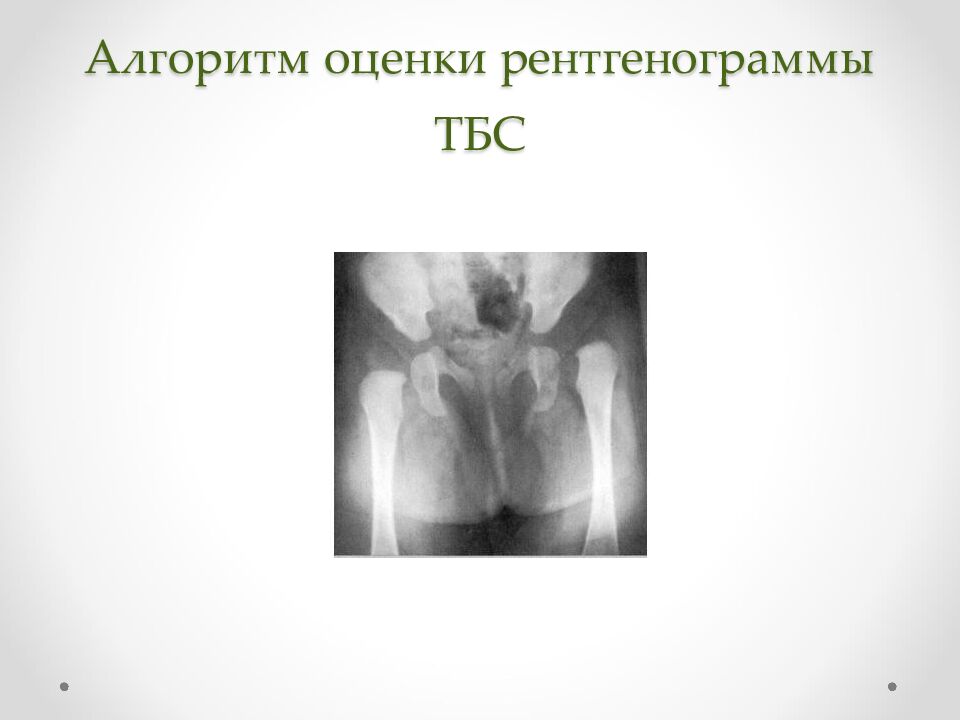 Алгоритм оценки рентгенограммы ТБС