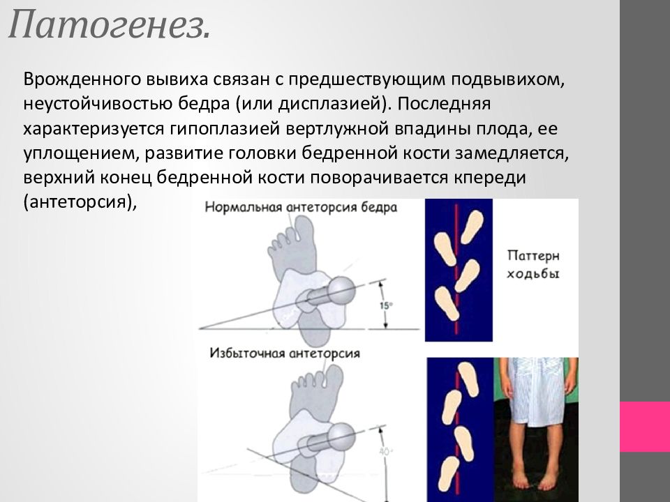 Для клинической картины врожденного вывиха бедра характерны симптомы