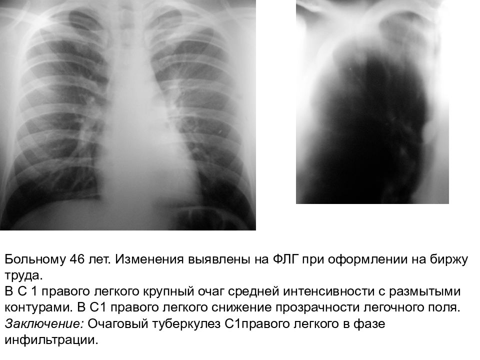 Нечеткие контуры очагов легкое. Четкие и нечеткие контуры образования ренгетн.