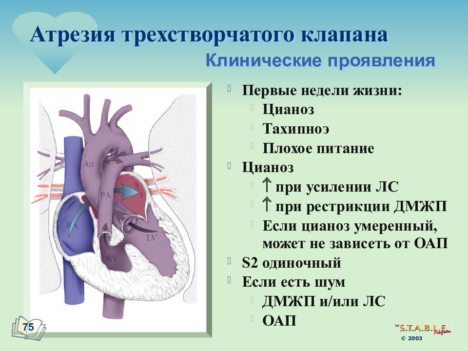 Атрезия трехстворчатого клапана презентация