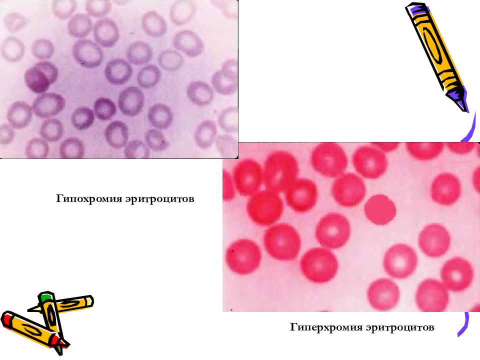 Гипохромия. Гипохромия и гиперхромия. Гиперхромия макроцитоз. Гипер хром гипо хром анемия.