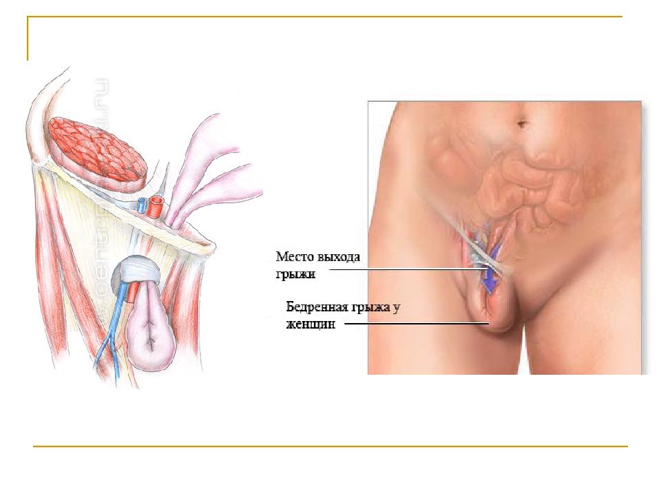 Бедренная грыжа картинки