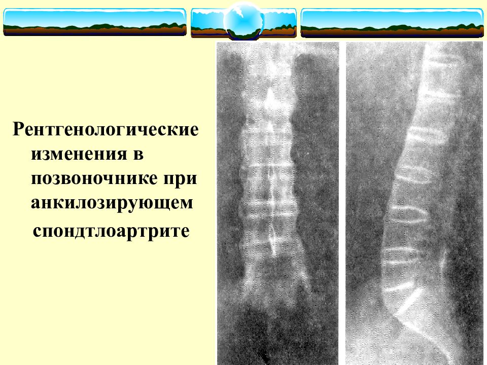 Анкилозирующий спондилоартрит презентация