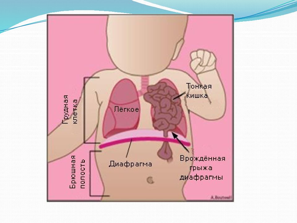 Врожденная диафрагмальная грыжа презентация