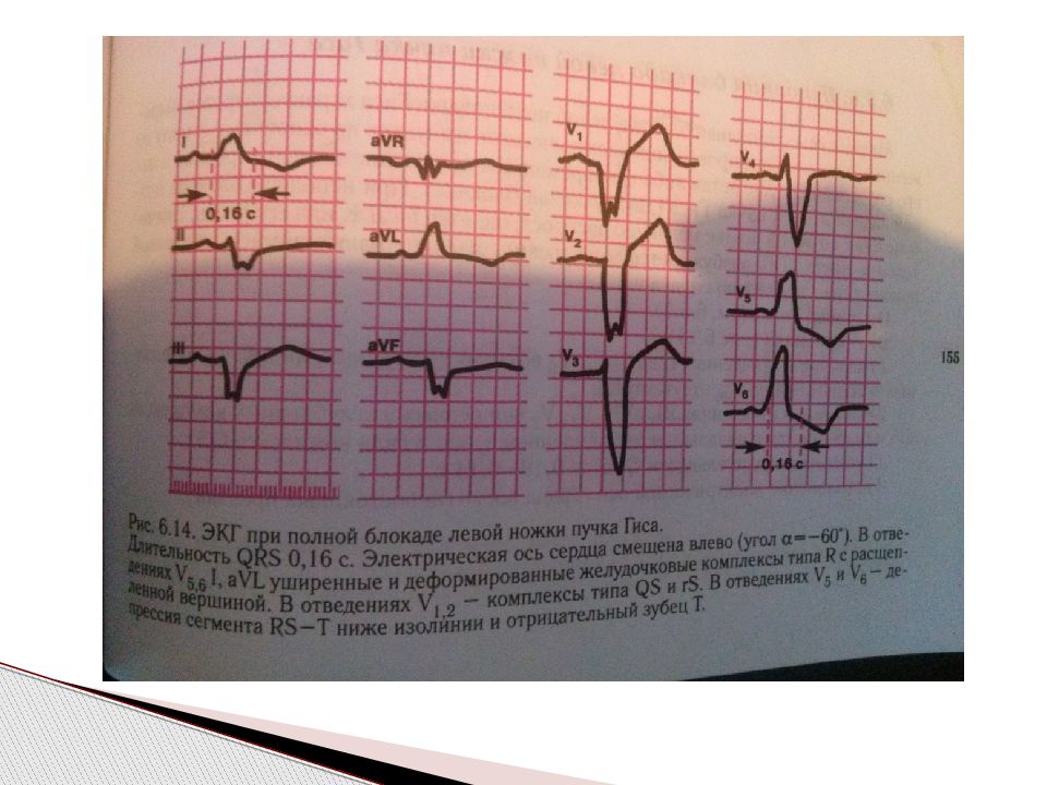 Нарушение проводимости на экг. Блокада левой ножки пучка Гиса (нарушение проводимости) ЭКГ. Картина ЭКГ при левосторонней блокаде. Нарушение внутрижелудочковой проводимости на ЭКГ У ребенка. Нарушение проводимости сердца презентация.